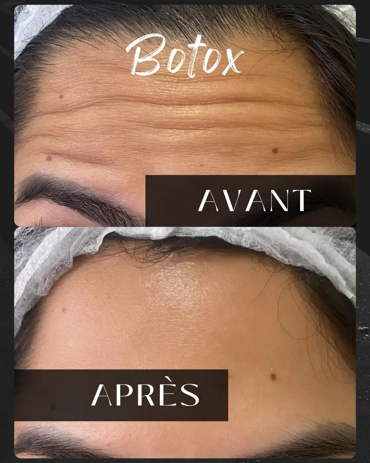 Résultat avant et après LipsClinic 3
