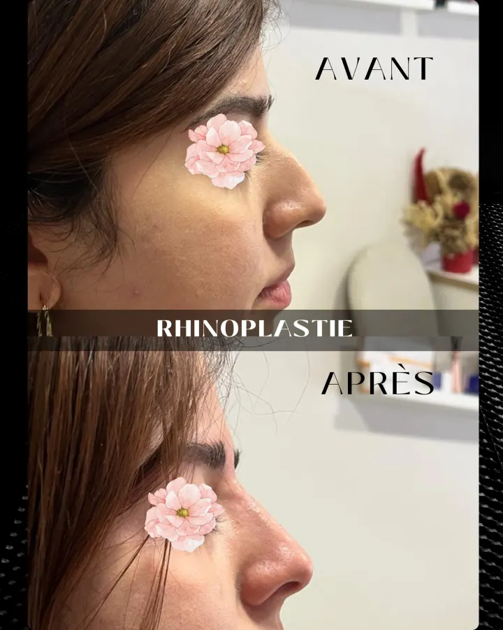 Résultat avant et après LipsClinic 4