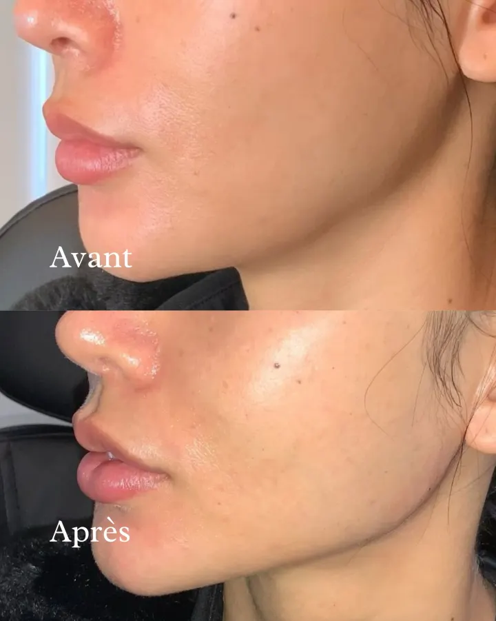 Résultat avant et après LipsClinic 8