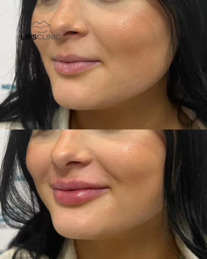Résultat avant et après LipsClinic 14