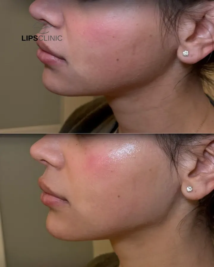 Résultat avant et après LipsClinic 9