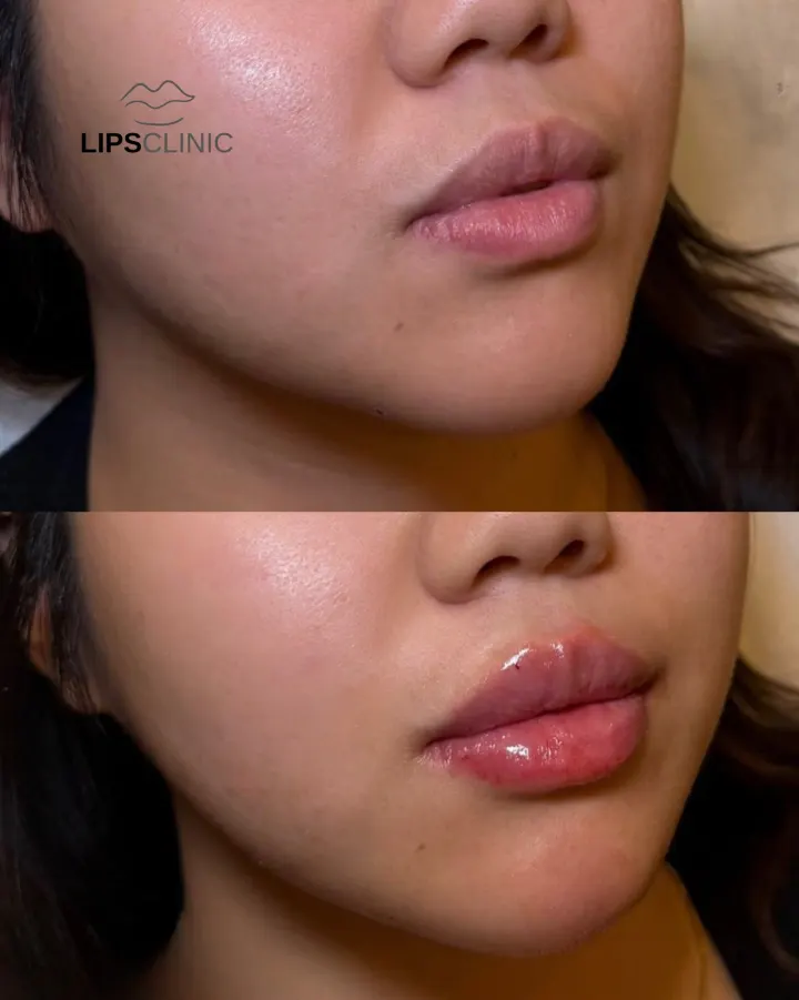 Résultat avant et après LipsClinic 12