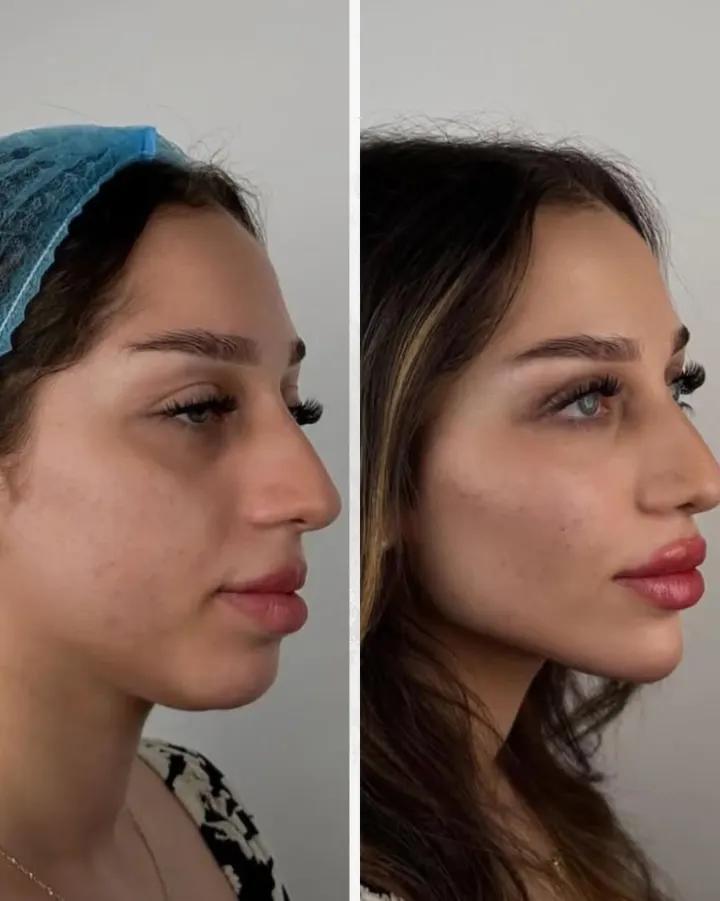 Résultat avant et après LipsClinic 13