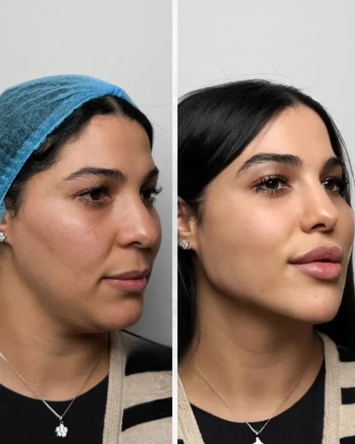 Résultat avant et après LipsClinic 10