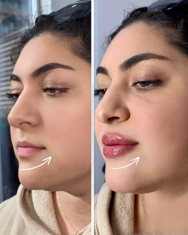 Résultat avant et après LipsClinic 5