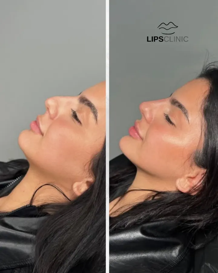 Résultat avant et après LipsClinic 2