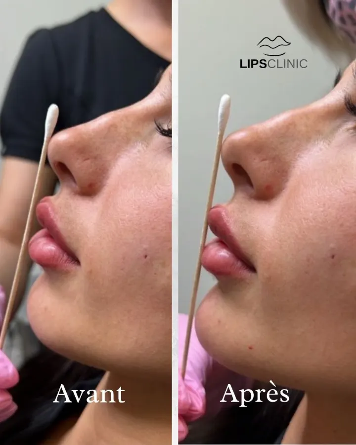 Résultat avant et après LipsClinic 1