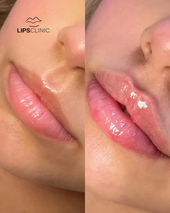 Résultat avant et après LipsClinic 6