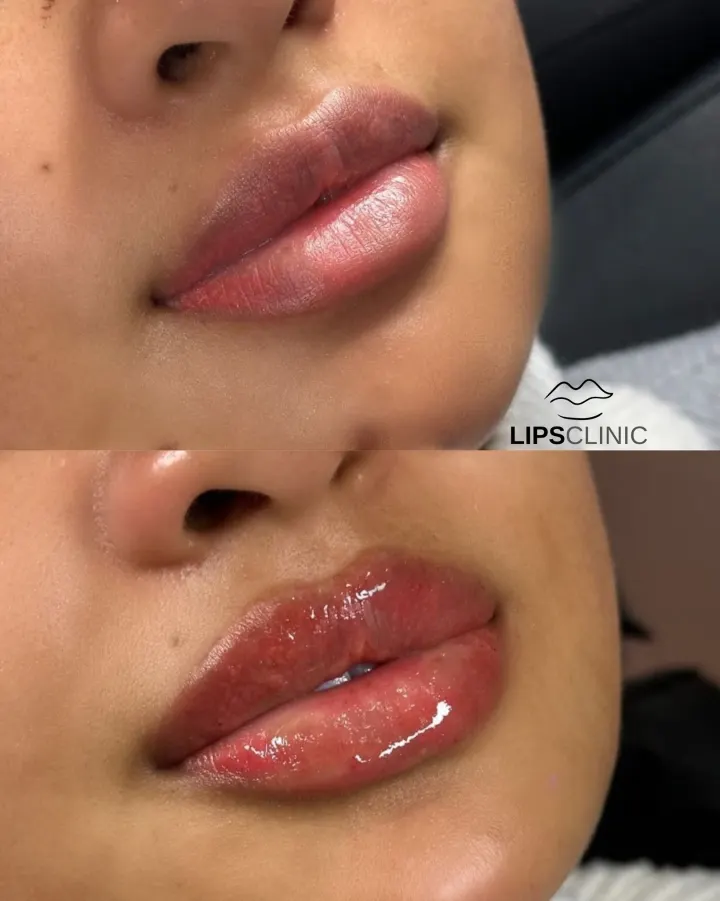 Résultat avant et après LipsClinic 7