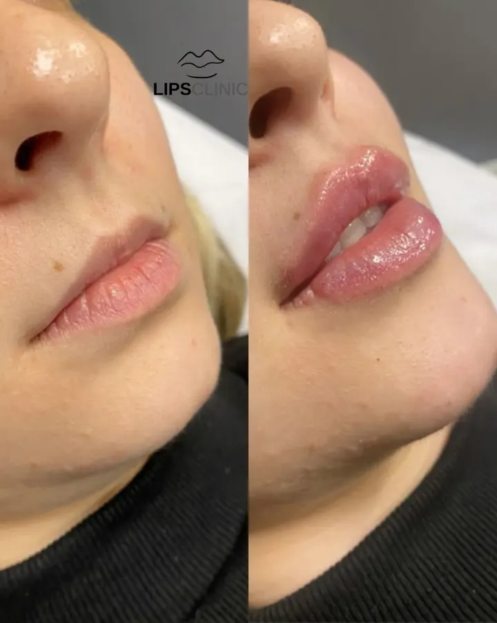 Résultat avant et après LipsClinic 11